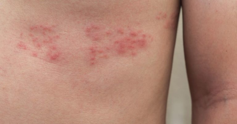 Pásový opar - herpes zoster